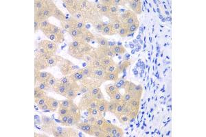 Immunohistochemistry of paraffin-embedded human liver cancer using CYP2C18 antibody. (CYP2C18 抗体)