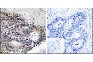 Immunohistochemistry analysis of paraffin-embedded human colon carcinoma, using ABHD12B Antibody. (ABHD12B 抗体  (AA 281-330))