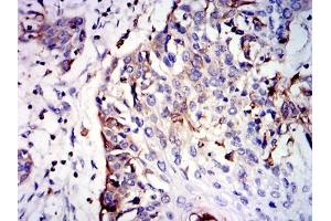 Immunohistochemical analysis of paraffin-embedded esophageal cancer tissues using GSTM1 mouse mAb with DAB staining. (GSTM1 抗体)