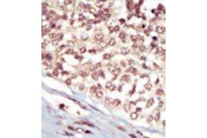Formalin-fixed and paraffin-embedded human cancer tissue reacted with the primary antibody, which was peroxidase-conjugated to the secondary antibody, followed by AEC staining. (EPH Receptor A5 抗体  (C-Term))