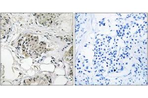 Immunohistochemistry analysis of paraffin-embedded human breast carcinoma tissue, using USP13 antibody. (USP13 抗体  (C-Term))