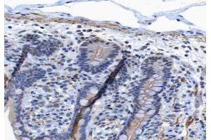 ABIN6267265 at 1/200 staining human colon carcinoma tissue sections by IHC-P. (EGFR 抗体  (pTyr1197))