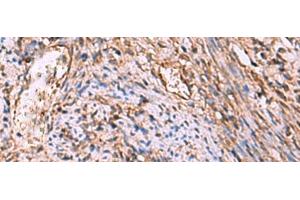 Immunohistochemistry of paraffin-embedded Human cervical cancer tissue using RHAG Polyclonal Antibody at dilution of 1:130(x200) (RHAG 抗体)