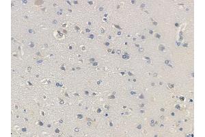 ABIN6259440 and ABIN6276270 at 1/100 staining human glioblastoma by IHC-P.