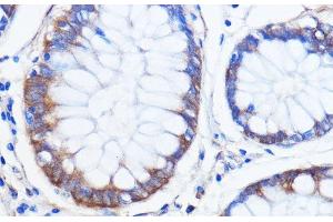 Immunohistochemistry of paraffin-embedded Human colon carcinoma using ATXN2 Polyclonal Antibody at dilution of 1:100 (40x lens). (Ataxin 2 抗体)