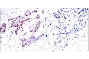 Immunohistochemistry analysis of paraffin-embedded human breast carcinoma, using STAT1 (Phospho-Tyr701) Antibody. (STAT1 抗体  (pTyr701))