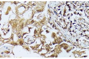 Immunohistochemistry of paraffin-embedded Human lung cancer using DAPK3 Polyclonal Antibody at dilution of 1:100 (40x lens). (DAPK3 抗体)