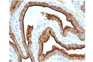 Epithelial Marker Antigen antibody IHC testing of formalin-paraffin human ovarian cancer tissue. (Epithelial Marker Antigen 抗体)