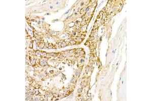 Immunohistochemistry of paraffin-embedded human lung cancer using B1 Rabbit pAb (ABIN6129916, ABIN6136962, ABIN6136963 and ABIN6222795) at dilution of 1:150 (40x lens). (AP3B1 抗体  (AA 895-1094))