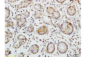 Formalin-fixed and paraffin embedded human colon carcinoma tissue labeled with Rabbit Anti-TEM1/CD248 Polyclonal Antibody (ABIN677573) at 1:200 followed by conjugation to the secondary antibody and DAB staining. (CD248 抗体  (AA 251-350))