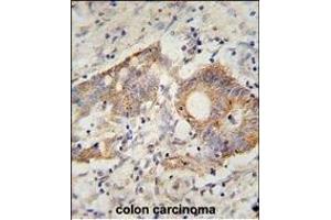 HHLA2 Antibody (N-term) (ABIN654607 and ABIN2844307) immunohistochemistry analysis in formalin fixed and paraffin embedded human colon carcinoma followed by peroxidase conjugation of the secondary antibody and DAB staining.