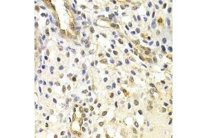 Immunohistochemistry of paraffin-embedded human uterine cancer using RAD50 Antibody. (RAD50 抗体)