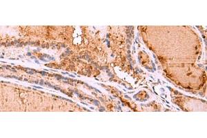 Immunohistochemistry of paraffin-embedded Human thyroid cancer tissue using HTRA4 Polyclonal Antibody at dilution of 1:35(x200) (HTRA4 抗体)