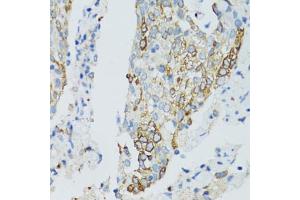 Immunohistochemistry of paraffin-embedded human lung cancer using SIRT2 antibody (ABIN5970103) at dilution of 1/100 (40x lens). (SIRT2 抗体)