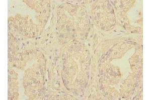 Immunohistochemistry of paraffin-embedded human prostate cancer using ABIN7161113 at dilution of 1:100 (nectin-3 抗体  (AA 310-549))