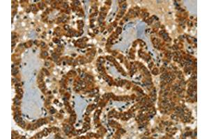 The image on the left is immunohistochemistry of paraffin-embedded Human thyroid cancer tissue using ABIN7190246(CHRDL2 Antibody) at dilution 1/20, on the right is treated with synthetic peptide. (CHRDL2 抗体)