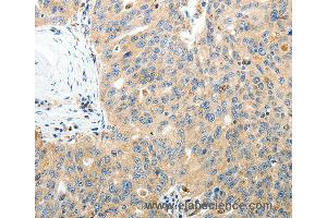 Immunohistochemistry of Human thyroid cancer using RAMP3 Polyclonal Antibody at dilution of 1:40 (RAMP3 抗体)