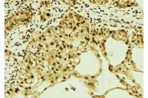 ABIN6276850 at 1/100 staining Human breast cancer tissue by IHC-P. (KPNA1 抗体  (N-Term))