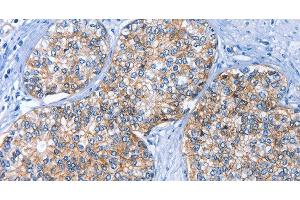 Immunohistochemistry of paraffin-embedded Human prostate cancer using CD239 Polyclonal Antibody at dilution of 1:40 (BCAM 抗体)