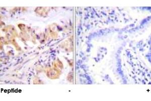 Immunohistochemical analysis of paraffin-embedded human lung carcinoma tissue using PTGES3 polyclonal antibody . (PTGES3 抗体  (Ser113))