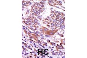Formalin-fixed and paraffin-embedded human hepatocellular carcinoma tissue reacted with CAMK2D polyclonal antibody  , which was peroxidase-conjugated to the secondary antibody, followed by AEC staining. (CAMK2D 抗体  (C-Term))