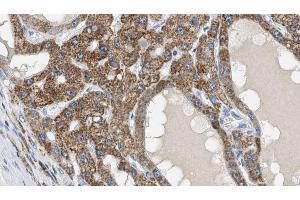 ABIN6269117 at 1/100 staining Human liver cancer tissue by IHC-P. (IGF1R 抗体  (C-Term))