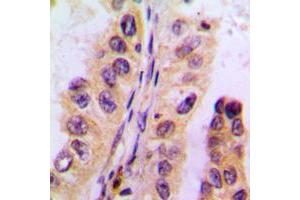 Immunohistochemical analysis of Cytochrome P450 3A4/5 staining in human liver cancer formalin fixed paraffin embedded tissue section. (Cytochrome P450 3A4, 3A5 (Center) 抗体)