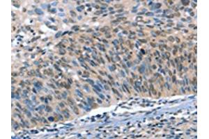 The image on the left is immunohistochemistry of paraffin-embedded Human cervical cancer tissue using ABIN7190052(CAMTA1 Antibody) at dilution 1/15, on the right is treated with synthetic peptide.
