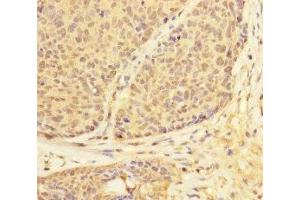 Immunohistochemistry of paraffin-embedded human ovarian cancer using ABIN7174303 at dilution of 1:100 (USP28 抗体  (AA 430-580))