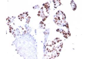 Formalin-fixed, paraffin-embedded human Breast Carcinoma stained with RNA Polymerase II / Poll II Mouse Monoclonal Antibody (CTD4H8). (POLR2A/RPB1 抗体  (pSer5))