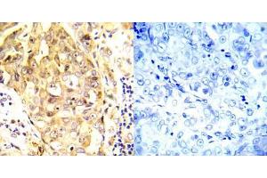 Immunohistochemical analysis of paraffin- embedded human breast carcinoma tissue using P53 (Ab-20) antibody (E022030). (p53 抗体)