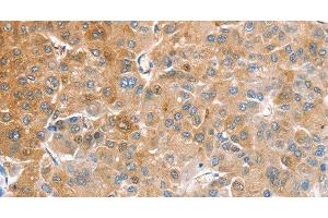 Immunohistochemistry of paraffin-embedded Human liver cancer tissue using CDR2 Polyclonal Antibody at dilution 1:60 (CDR2 抗体)