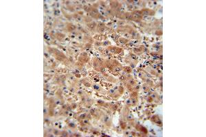 ASAP3 antibody immunohistochemistry analysis in formalin fixed and paraffin embedded human hepatocarcinoma followed by peroxidase conjugation of the secondary antibody and DAB staining. (ASAP3 抗体  (N-Term))