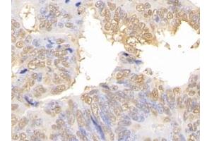 Detection of GAL3 in Human Colorectal cancer Tissue using Polyclonal Antibody to Galectin 3 (GAL3) (Galectin 3 抗体  (AA 1-250))