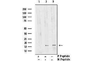 Western blot analysis of Human breast carcinoma lysates using Phospho-FUNDC1 (Ser17) antibody.