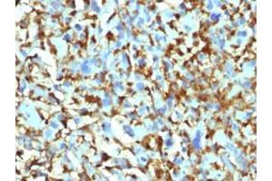 Immunohistochemical staining (Formalin-fixed paraffin-embedded sections) of human histiocytoma with F13A1 monoclonal antibody, clone F13A1/1448 . (F13A1 抗体  (AA 46-181))