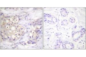 Immunohistochemistry analysis of paraffin-embedded human breast carcinoma, using PKC alpha (Phospho-Thr638) Antibody. (PKC alpha 抗体  (pThr638))