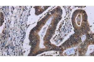 Immunohistochemistry of paraffin-embedded Human ovarian cancer tissue using ITGAE Polyclonal Antibody at dilution of 1:50 (CD103 抗体)