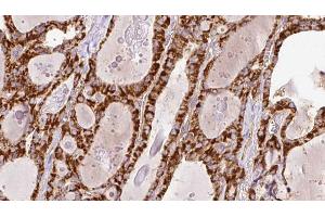 ABIN6266447 at 1/100 staining Human thyroid cancer tissue by IHC-P.