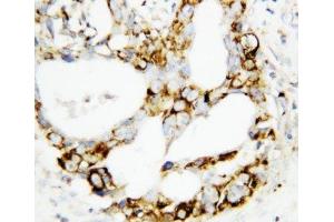 IHC-P: MEK3 antibody testing of human breast cancer tissue (MAP2K3 抗体  (C-Term))