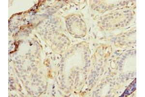 Immunohistochemistry of paraffin-embedded human breast cancer using ABIN7175174 at dilution of 1:100 (RAD23B 抗体  (AA 1-250))