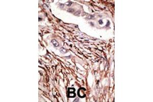 Formalin-fixed and paraffin-embedded human breast cancer tissue reacted with NOTCH3 polyclonal antibody  , which was peroxidase-conjugated to the secondary antibody, followed by DAB staining. (NOTCH3 抗体  (C-Term))