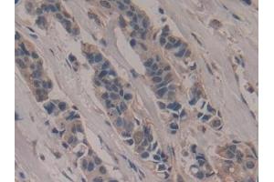 Detection of PVR in Human Breast cancer Tissue using Polyclonal Antibody to Poliovirus Receptor (PVR) (Poliovirus Receptor 抗体  (AA 56-309))