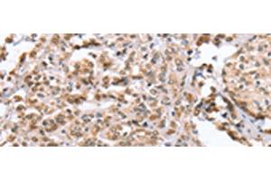 Immunohistochemistry of paraffin-embedded Human prost at e cancer tissue using ZFYVE16 Polyclonal Antibody at dilution of 1:60(x200) (ZFYVE16 抗体)