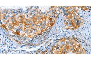 Immunohistochemistry of paraffin-embedded Human cervical cancer tissue using AIP Polyclonal Antibody at dilution 1:80 (AIP 抗体)
