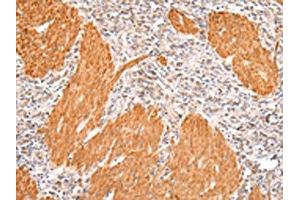 The image on the left is immunohistochemistry of paraffin-embedded Human gastric cancer tissue using ABIN7191067(IKZF4 Antibody) at dilution 1/20, on the right is treated with synthetic peptide. (IKZF4 抗体)