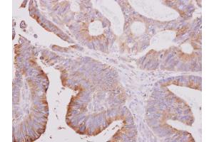 IHC-P Image beta Tubulin 2 antibody [N1C1] detects beta Tubulin 2 protein at cytoplasm on human colon carcinoma by immunohistochemical analysis. (TUBB2A 抗体)