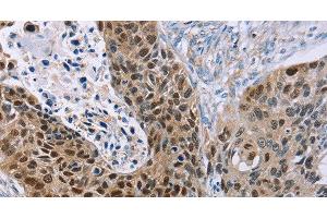 Immunohistochemistry of paraffin-embedded Human esophagus cancer using MAGEA10 Polyclonal Antibody at dilution of 1:30 (MAGEA10 抗体)