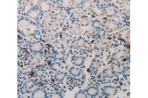 IHC-P analysis of stomach cancer tissue, with DAB staining. (Midkine 抗体  (AA 22-143))