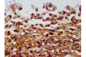 IHC image of ABIN7148018 diluted at 1:400 and staining in paraffin-embedded human melanoma performed on a Leica BondTM system. (COPG2 抗体  (AA 676-823))